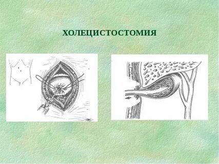 Холецистостомия операция
