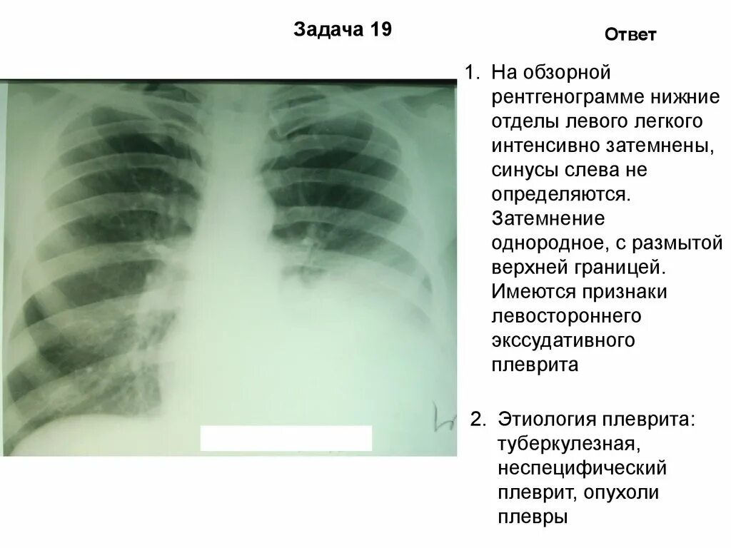 Затемнение в левом легком. Туберкулез плеврит рентген. Экссудативный плеврит рентген описание. Плеврит легких рентген описание. Рентгенограмма при туберкулезном плеврите.