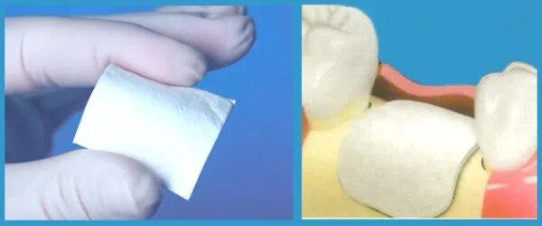 Collprotect membrane botiss. Регенерации клеточной ткани. Материал для регенерации. Клеточная и внутриклеточная формы регенерации. Мембрана стоматологическая для тканевой регенерации.