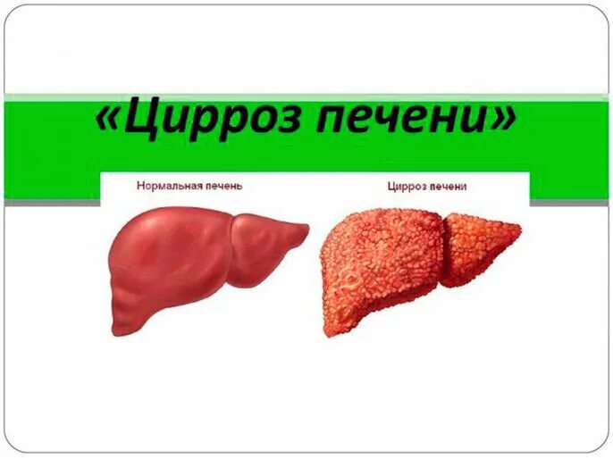 Сколько живут с циррозом печени при гепатите. Цирроз печени сколько живут. сколькоживут с церросом печени.