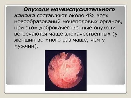 Рак уретры клинические рекомендации 2023