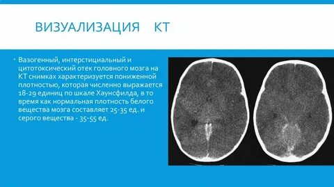 Плотность головного мозга