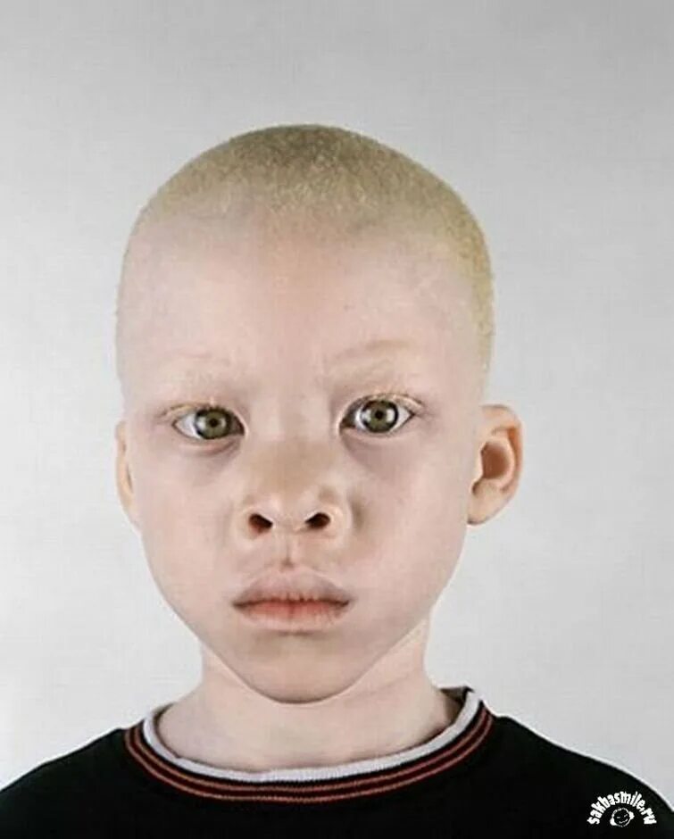 Альбинос негроидной расы. Альбиносы люди негроиды.