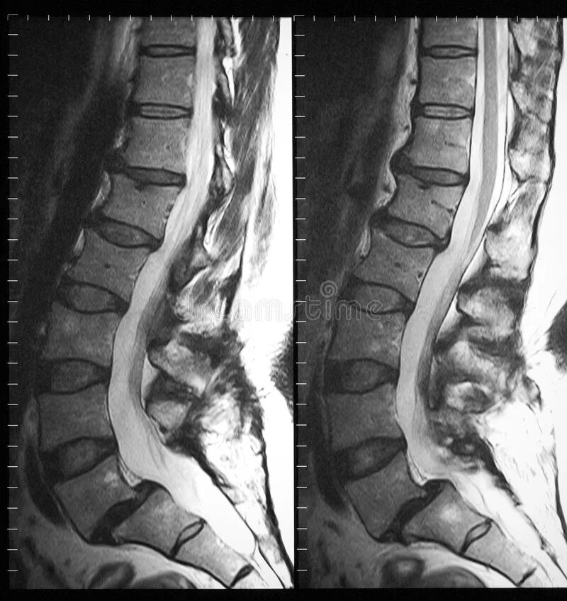 Киста в пояснице. Мрт пояснично-крестцово-копчикового отдела позвоночника. Спондилолистез пояснично-крестцового отдела позвоночника мрт. Мрт пояснично-крестцового отдела позвоночника и копчика. Мрт пояснично-крестцового отдела и копчика.