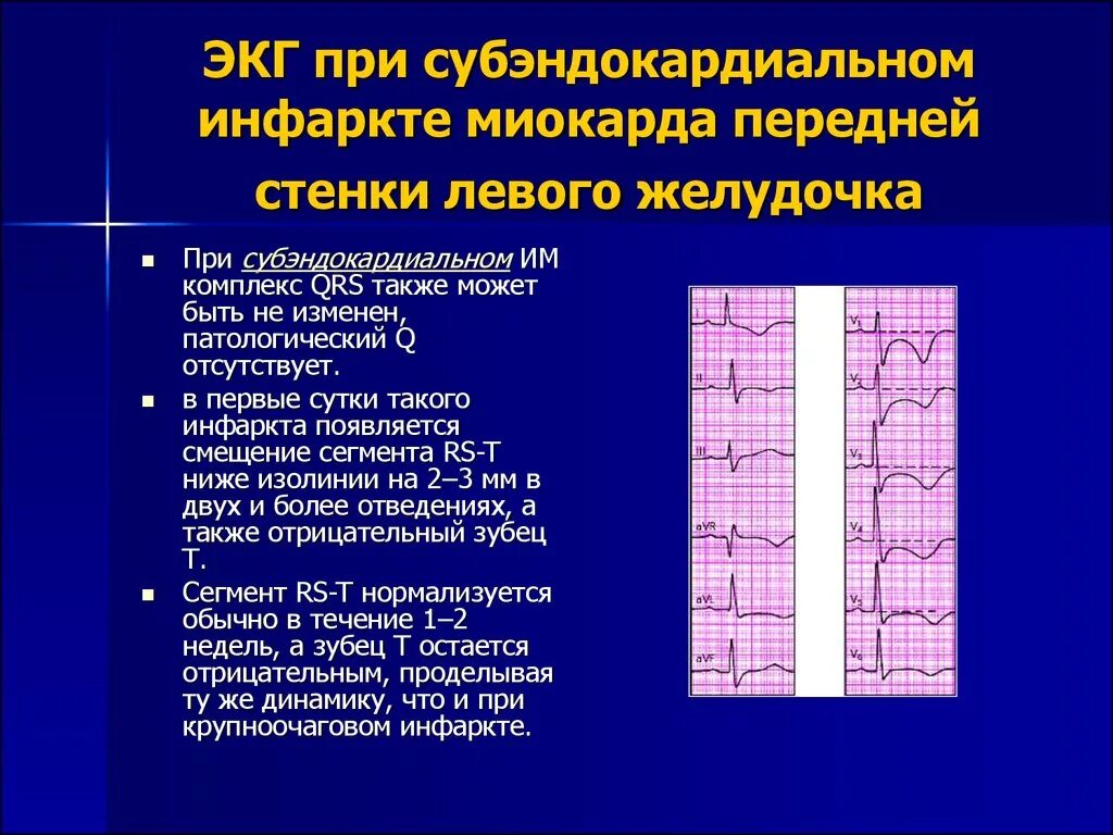 Острый субэндокардиальный инфаркт миокарда ЭКГ. ЭКГ при субэпикардиальном инфаркте. ЭКГ при трансмуральном инфаркте нижней стенки. ЭКГ признаки субэпикардиального инфаркта миокарда. Изменения в нижней стенке левого желудочка