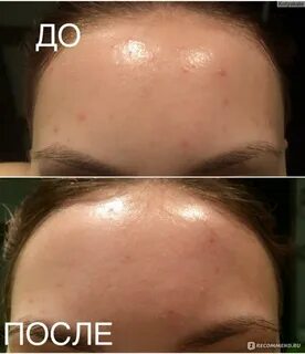 Клензит с от прыщей отзывы