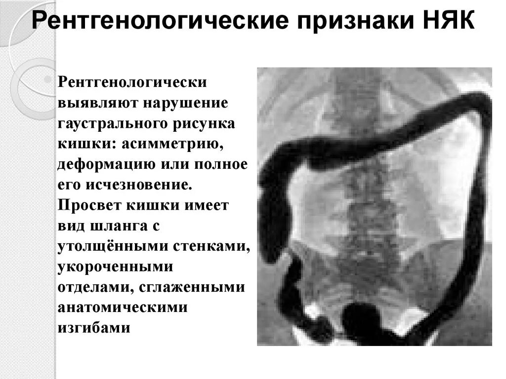 Язвенный колит ирригография. Рентген кишечника язвенный колит. Язвенный колит ирригоскопия. Неспецифический язвенный колит ирригоскопия.