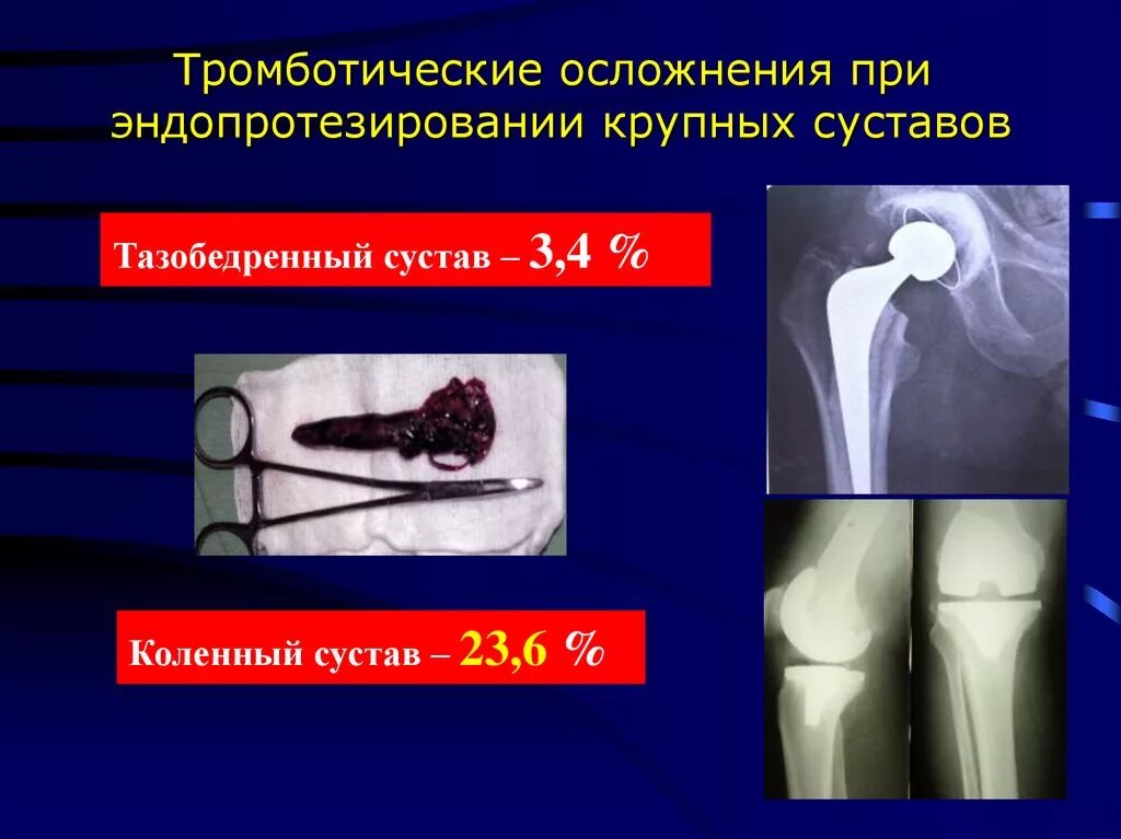 Отек после эндопротезирования тазобедренного