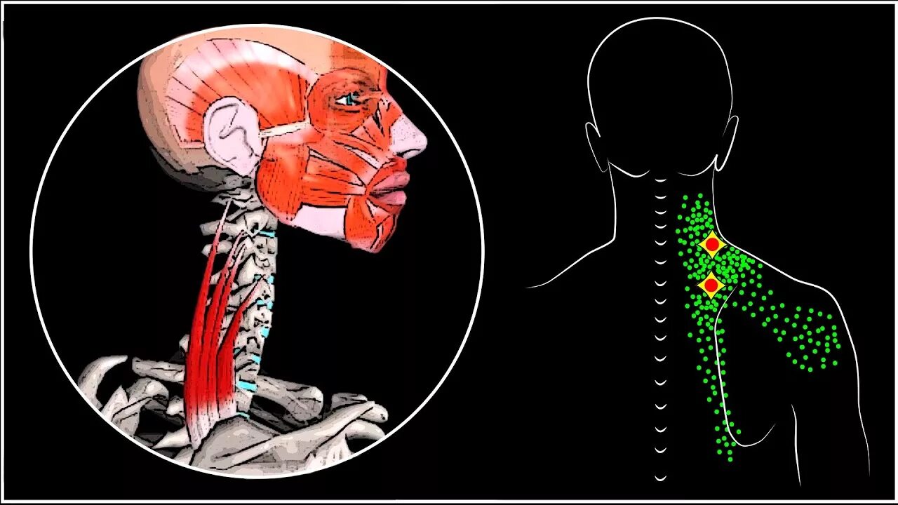 Болит голова и мышцы шеи. Ременная мышца шеи триггерные точки. Ременная мышца головы триггерные точки. Мышца поднимающая лопатку триггерные точки. Триггерные точки в лестничных мышцах шеи.