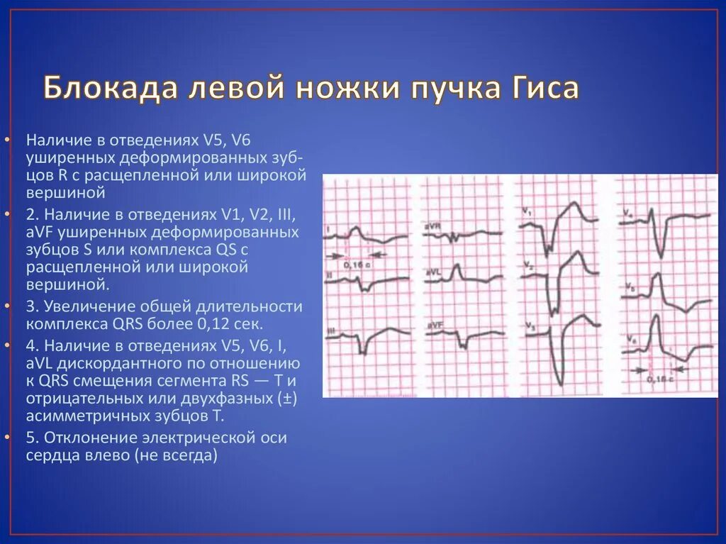 Полная блокада ножек гиса лечение. Блокада левой ножки пучка ги а. Блокада левой ножки пучка Гиса. Блокада левой ножки пучка Гиса на ЭКГ. Признаки блокады левой ножки пучка Гиса на ЭКГ.