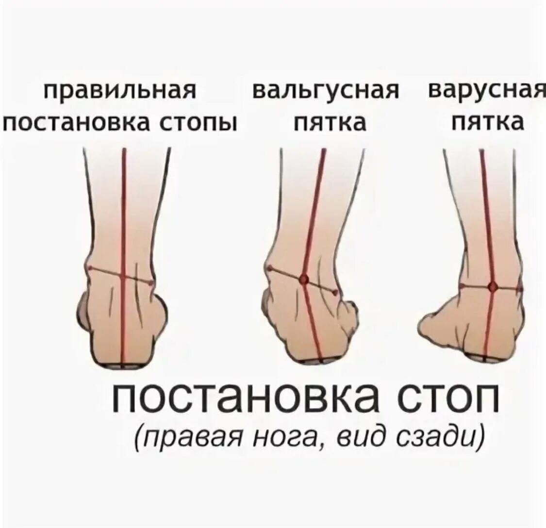 Вальгусная стопа у ребенка код мкб