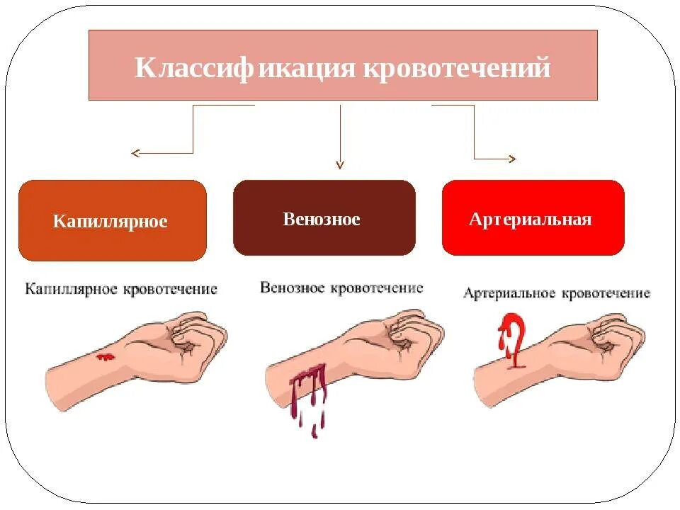 Какие кровотечения относятся. Классификация внешних кровотечений. артериальное венозное и капиллярное кровотечение. схема типы кровотечений. кровотечения классификация первая помощь.