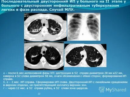 Типы инфильтрации легких