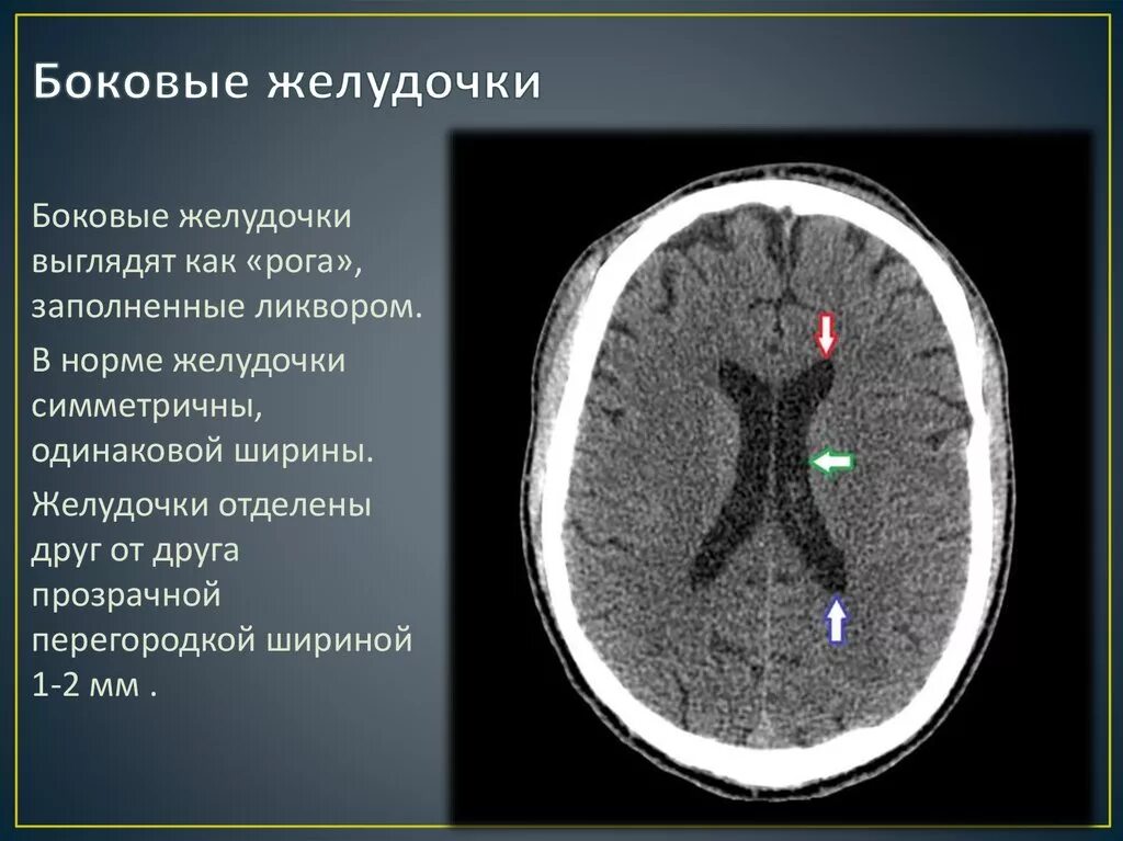 Боковые желудочки анатомия кт. Боковые желудочки головного мозга кт. Расширение бокового желудочка головного мозга на кт. Измерение желудочков мозга на кт.