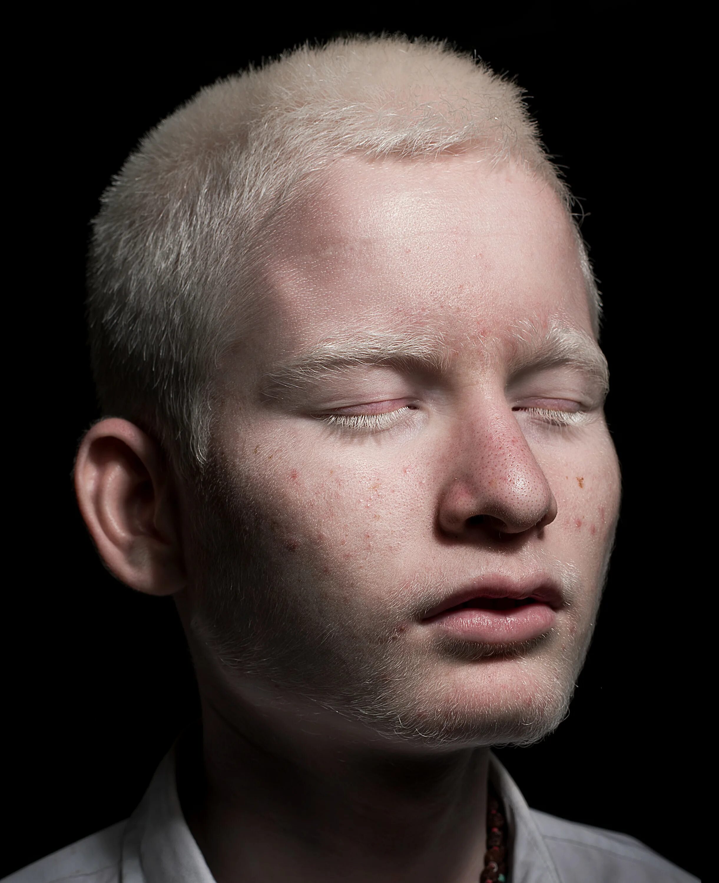 Глазокожный альбинизм 1 ГКА. Глазокожный альбинизм Тип 1а. Глазокожный альбинизм Тип 3.