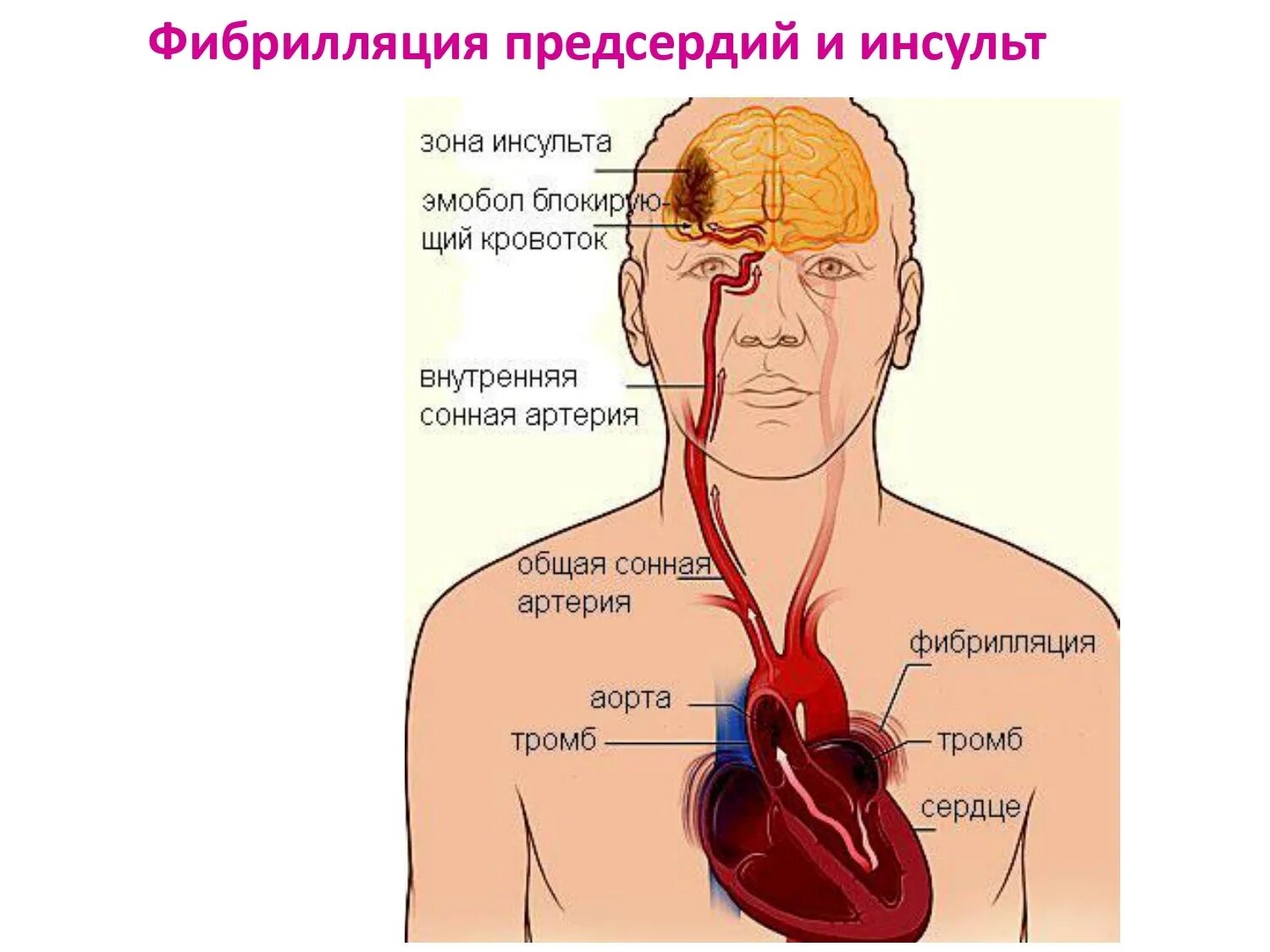 Тромб в сердце оторвался. Тромбоз сердца симптомы.