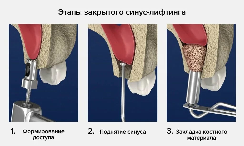 Синус лифтинг в стоматологии что это