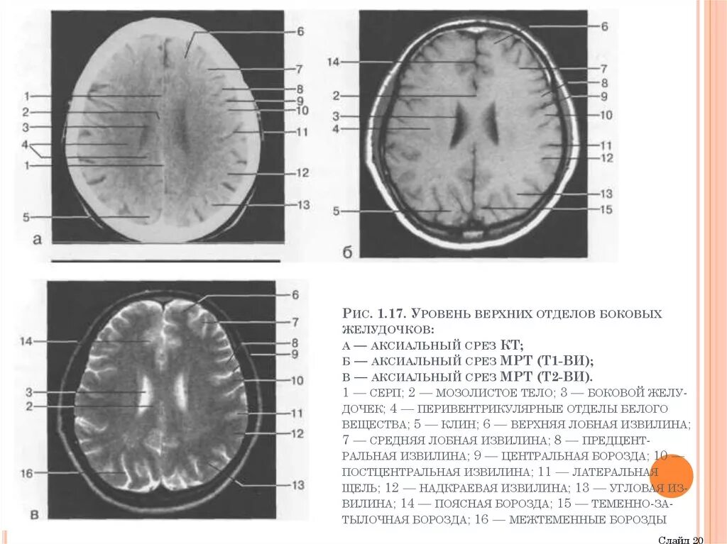 Мрт головного мозга аксиальный срез. Кт анатомия головного мозга аксиальные срезы. Кт головного мозга аксиальный срез. Головной мозг анатомия мрт аксиальные срезы головного. Изменения боковых отделов