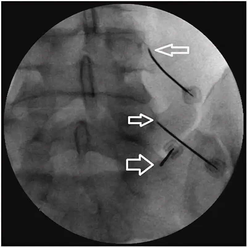 Фасеточная блокада. Блокада фасеточного сустава l5-s1. Блокада фасеточных суставов поясничного отдела позвоночника. Блокада фасеточных суставов под контролем рентгена. Блокада корешка l5-s1 техника.