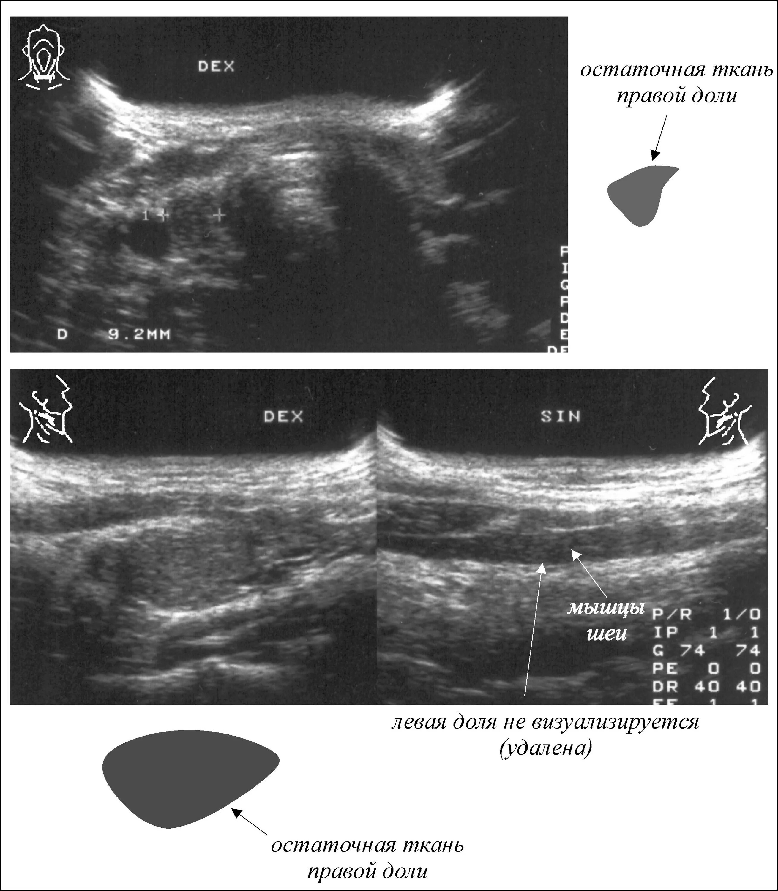 Частичный аномальный дренаж легочных вен у новорожденных эхокг. Расширение протока поджелудочной железы на узи. Трубы не визуализируются что это значит. Трубы не визуализируются что это значит. Трубы не визуализируются что это значит.
