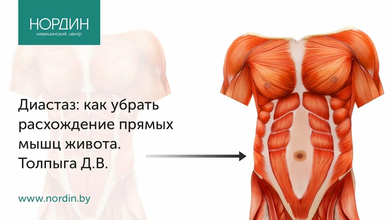 Прямые мышцы живота у мужчин. Диастаз прямых мышц живота у мужчин. Прямая мышца живота диастаз. Диастаз мышц брюшного пресса.