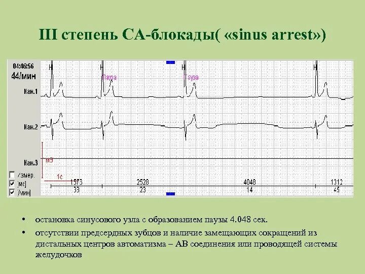 Блокада узла. Са блокада 2 степени 2 типа. Са блокада 3 степени на ЭКГ. Са блокада 2 степени 2 с паузами. Са блокада 1 степени на ЭКГ.