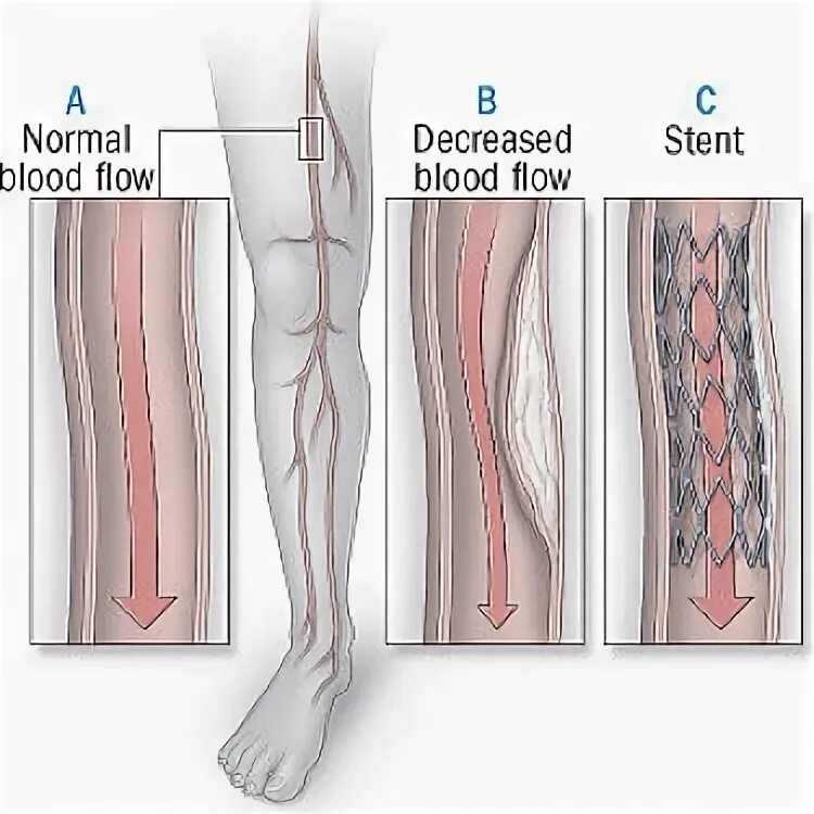 Стентирование сосудов конечностей. Стентирование атеросклерозе артерий конечностей. Стентирование вен нижних конечностей. Ангиопластика сосудов нижних конечностей. Операция на сосудах нижних конечностей