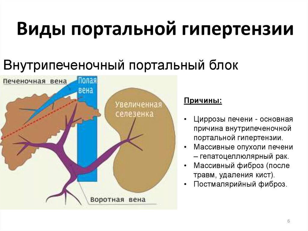 Расширение селезеночных вен