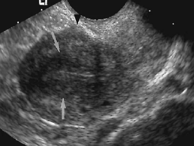 Лейомиосаркома матки УЗИ. УЗИ признаки эндометриомы. Эндометриоз миометрия. Полость в эндометрии