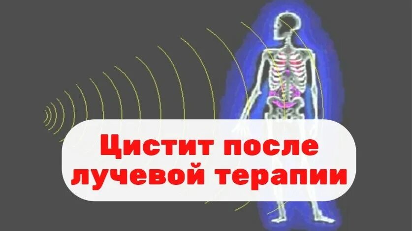 После лучевой цистит. Лучевой цистит у женщин. Лучевой цистит у мужчин после лучевой терапии.