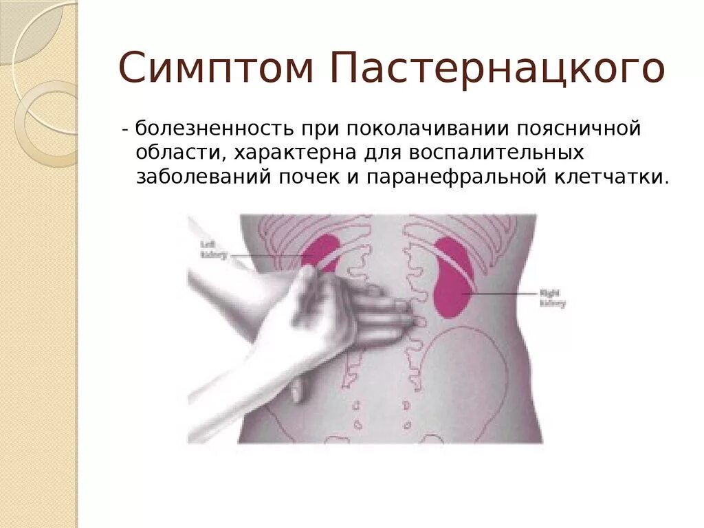 Увеличение и болезненность. Симптом Пастернацкого методика проведения. Острый пиелонефрит пальпация. Методика оценки симптома Пастернацкого. Острый пиелонефрит симптом Пастернацкого.