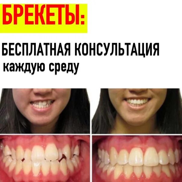 Зубы при закрытом рте