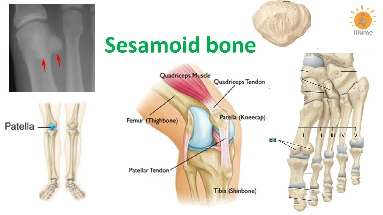 Sesamoid Bone Patella. Bone meaning