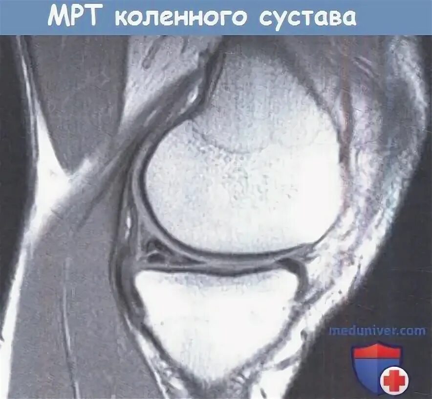 Мрт коленного сустава набережные. Мрт коленного сустава.