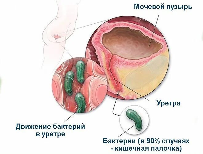 Воспаление мочевого пузыря. Воспаленный мочевой пузырь. Воспалительные заболевания мочевого пузыря.