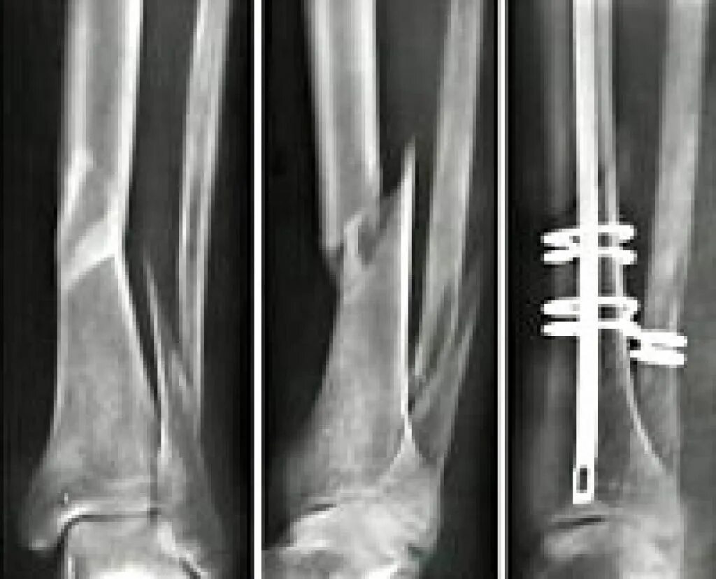 Сколько времени заживает нога. Винтообразный перелом берцовой кости. Винтообразный перелом голени. Винтообразный перелом большеберцовой кости рентген. Винтообразный перелом бедренной кости рентген.