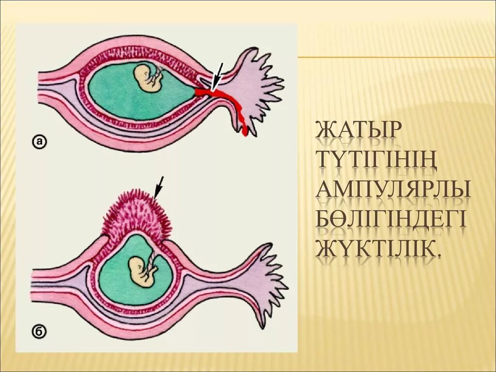 Наружный разрыв. Разрыв маточной трубы и трубный аборт. Внематочная беременность по типу трубного выкидыша. Внематочная беременность Трубная беременность. Внематочная беременность трубный разрыв.