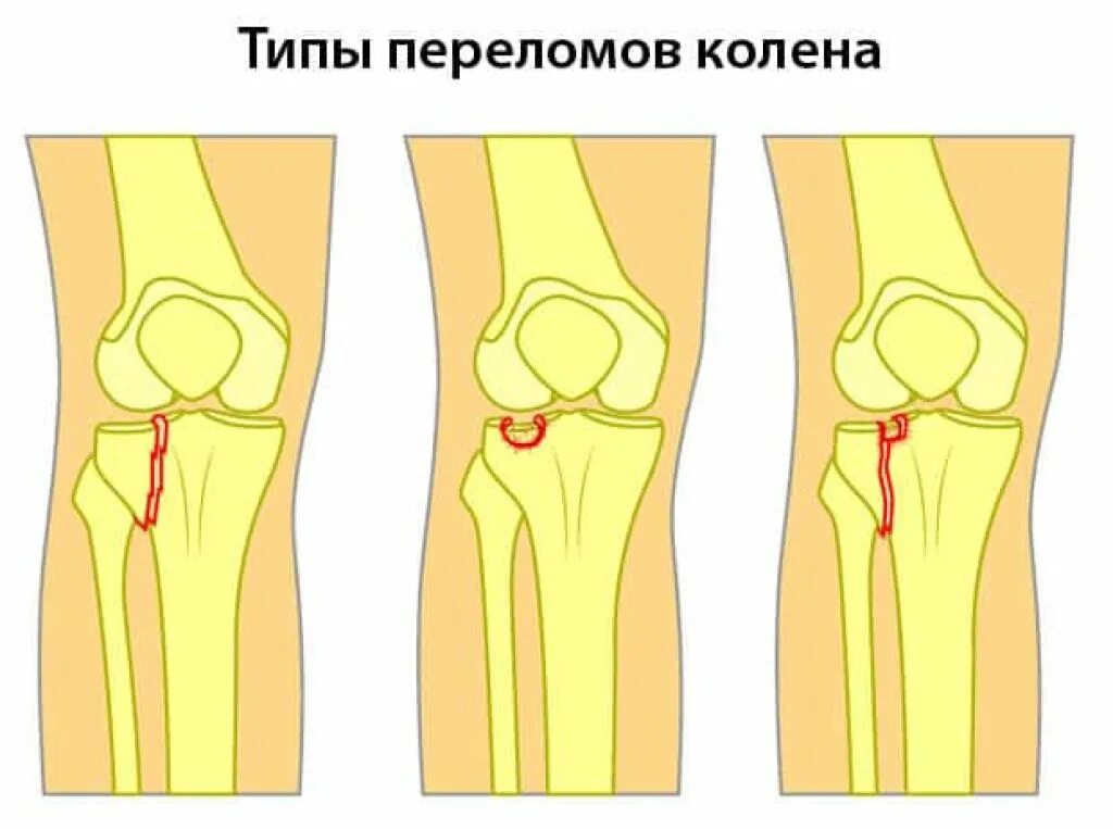 Трещина симптомы лечение. Компрессионный перелом большеберцовой кости коленного сустава. Травма надколенника коленного сустава. Типы перелома надколенника.