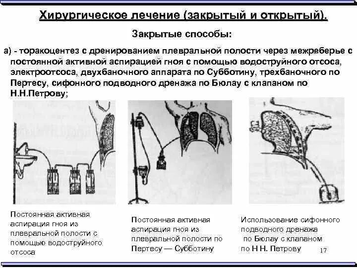 Закрытое дренирование (торакоцентез).. Дренирование полости эмпием. Пункция и дренирование плевральной полости. Методика дренирования плевральной полости.