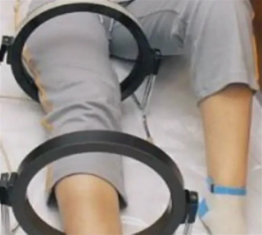 Аппарат механотерапии fisiotek 2000ts. Электрофорез голеностопного сустава. Физиотерапия переломов костей. Магнитотерапия полюс 2 на коленный сустав. Электростимуляция мышц нижних конечностей.