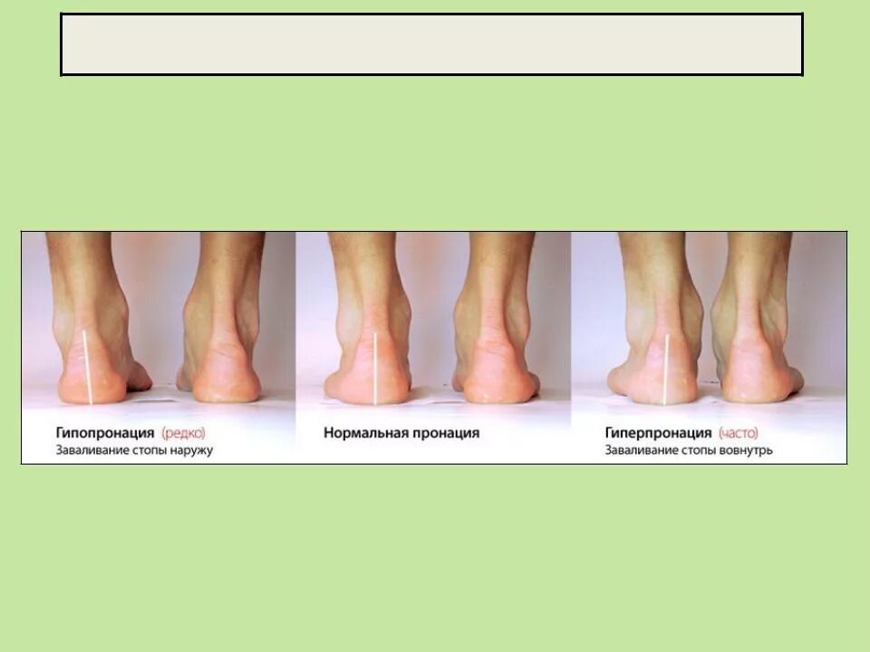 Пронация стопы гиперпронация. Плоскостопие пронация стопы. Пронация вальгус стопы. Гипопронация стопы стельки.