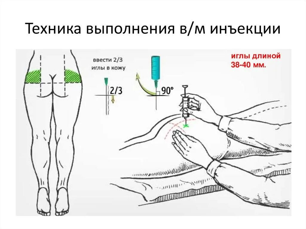 Глубина иглы при внутримышечной инъекции. Внутримышечная инъекция инъекция алгоритм выполнения. Подготовка внутримышечной инъекции алгоритм. Алгоритм внутримышечной инъекции схема. Введение внутримышечной инъекции в ягодицу алгоритм.