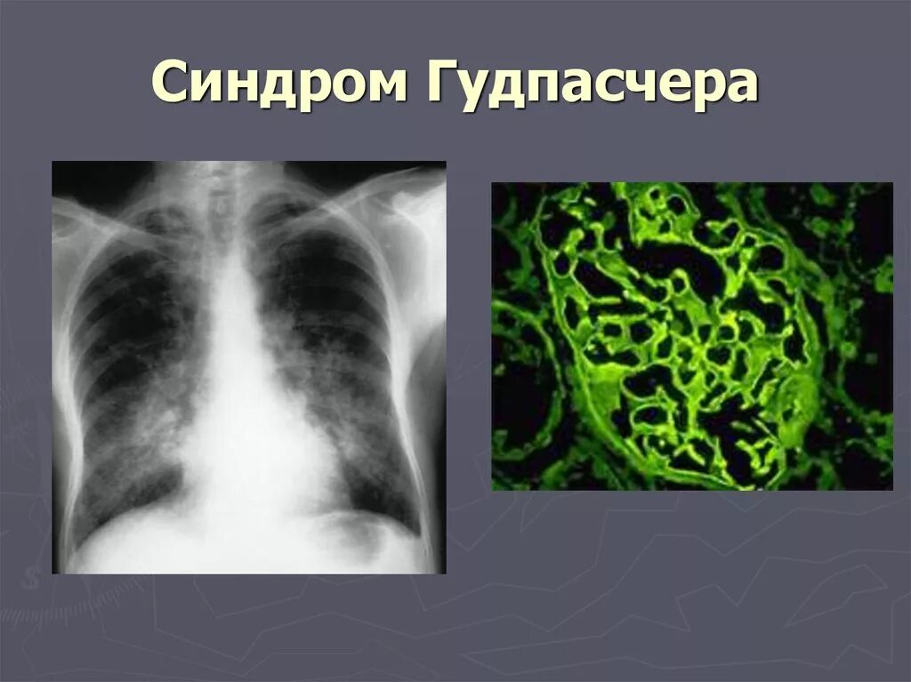 Синдром гудпасчера это. Синдром гудпасчера рентген. синдром гудпасчера патанатомия. синдром гудпасчера клинические рекомендации.