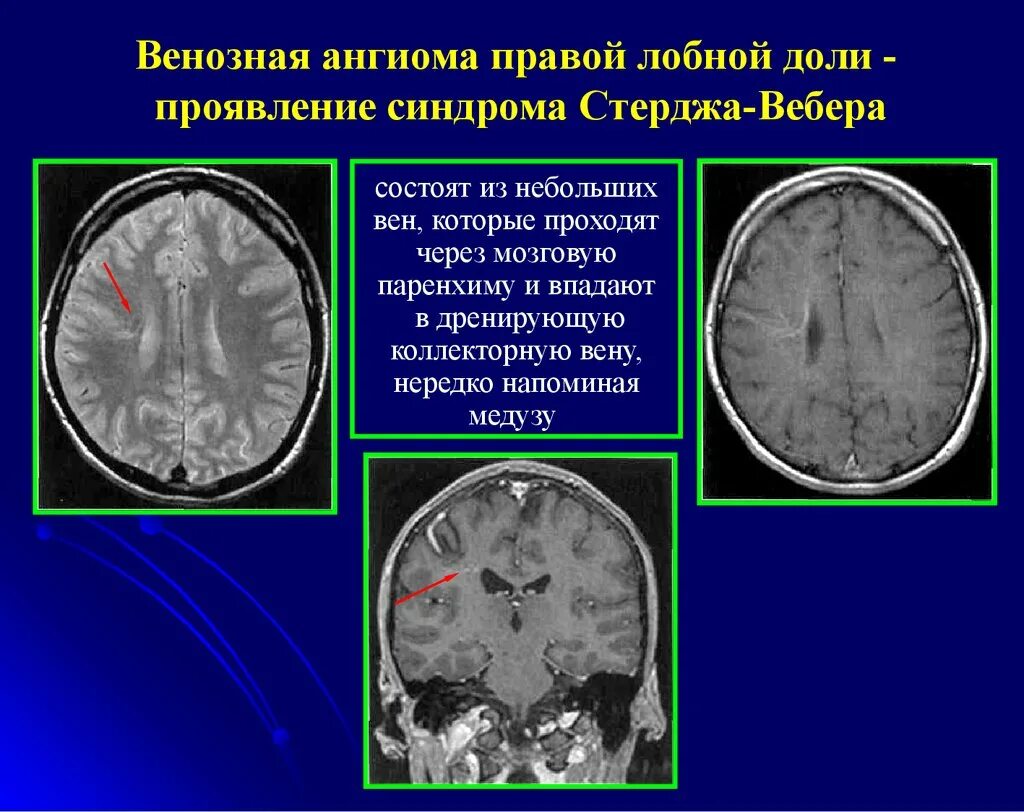 Гроздьевидная ангиома. Ангиома головного мозга кт. Сосудистая мальформация головного мозга на кт. Венозная мальформация головного мозга кт. Ангиома правой лобной