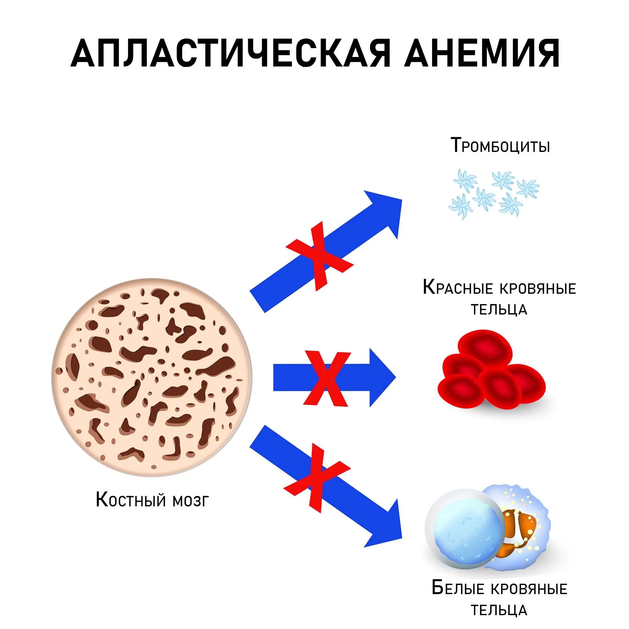 Апластическая анемия это. Апластическая анемия это