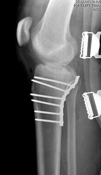 Остеосинтез мыщелка большеберцовой кости. Остеосинтез мыщелков бедра 2 пластинами. Перелом большеберцовой кости проксимального диафиза,. Перелом мыщелка большеберцовой кости остеосинтез рентген. Остеосинтез мыщелка