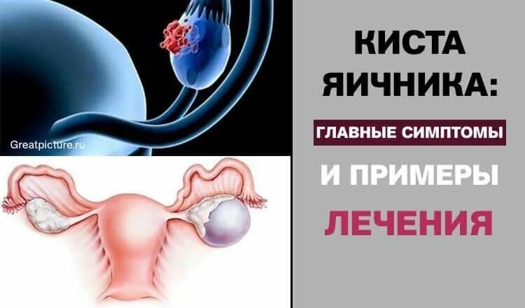 Народные средства от кисты яичника. Симптомы кистомыяичника. Симптомы кичтомы яичника. Киста яичников симптомы.