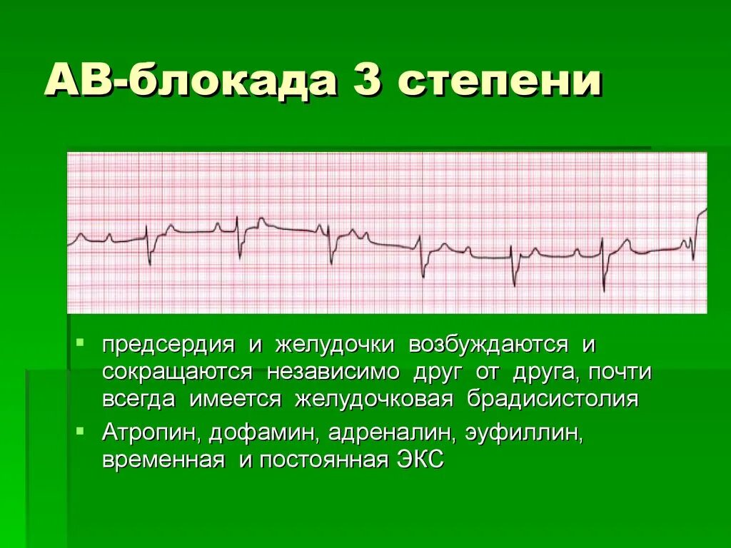 Fuller av. Атриовентрикулярная блокада 3 степени на ЭКГ. Полная атриовентрикулярная блокада 3 степени на ЭКГ. АВ блокада 3 степени ритм. АВ блокада 3 степени пленка ЭКГ.