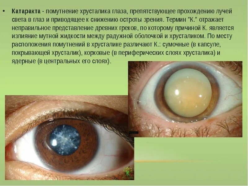 Катаракта глаза симптомы. Веретенообразная катаракта. Катаракта клиническая картина. Морганиевая катаракта. Морганиевая катаракта.