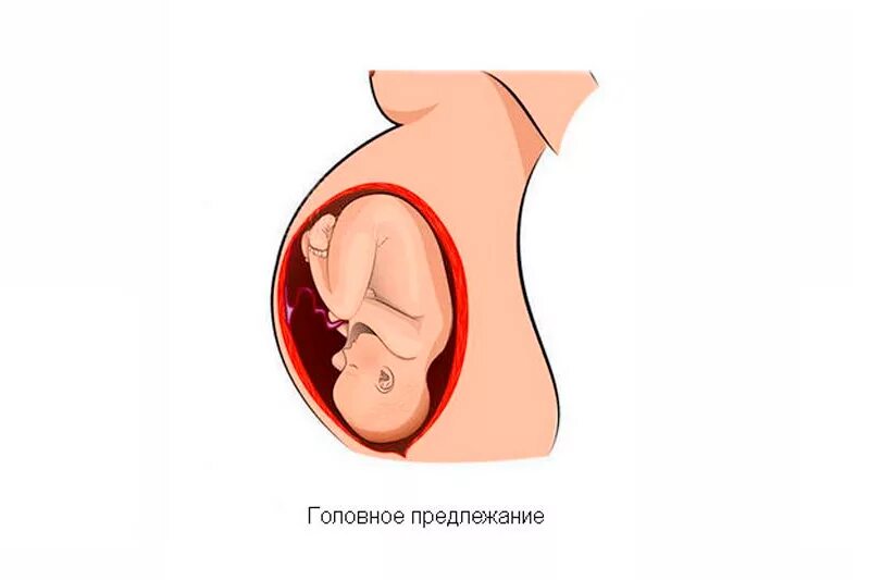 Правильное предлежание. Продольно головное предлежание плода. Продольное расположение плода при беременности 30 недель. Головное продольное предлежание плода при беременности. Продольное головное предлежание плода при беременности на 30 неделе.